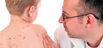 El sarampión acelera en el AMBA: Piden campaña de vacunación urgente
